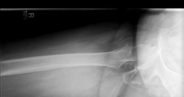 Illustration 5 for Analyzing a Hybrid Primary Hip Arthroplasty Patient Case