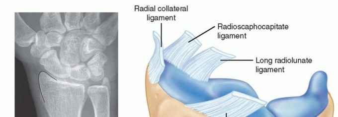 Open and Arthroscopic Radial Styloidectomy