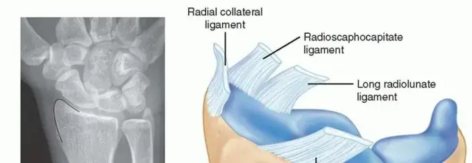 صورة توضيحية لـ وداعاً لألم الرسغ: كل ما تحتاج معرفته عن استئصال النتوء الإبري الكعبري وعلاجه في اليمن