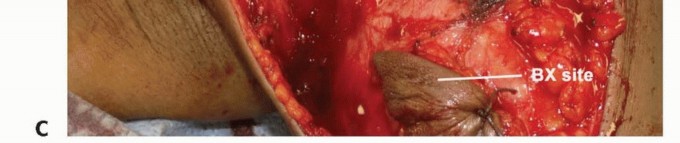 صورة طبية: استئصال أورام الكتف مع الحفاظ على الطرف: أحدث التقنيات لنتائج مثالية مع الأستاذ الدكتور محمد هطيف