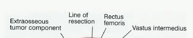 صورة توضيحية لـ استئصال عظم الفخذ البعيد المتقدم: جراحة الحفاظ على الأطراف ونتائجها في صنعاء مع الأستاذ الدكتور محمد هطيف