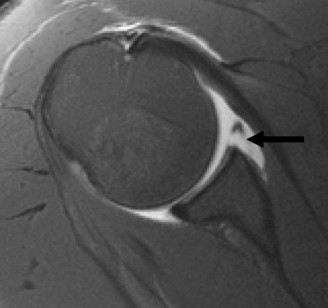 Illustration 6 for Right Shoulder Pain? Avoid This Common X-ray Mistake.