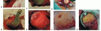 صورة طبية: ترميم مفصل الورك: الحل الأمثل للحفاظ على عظم رأس الفخذ في صنعاء مع الدكتور محمد هطيف
