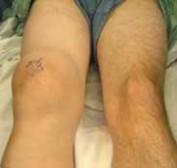 End Chronic Synovitis: Arthroscopic Relief with Portal & Shaver