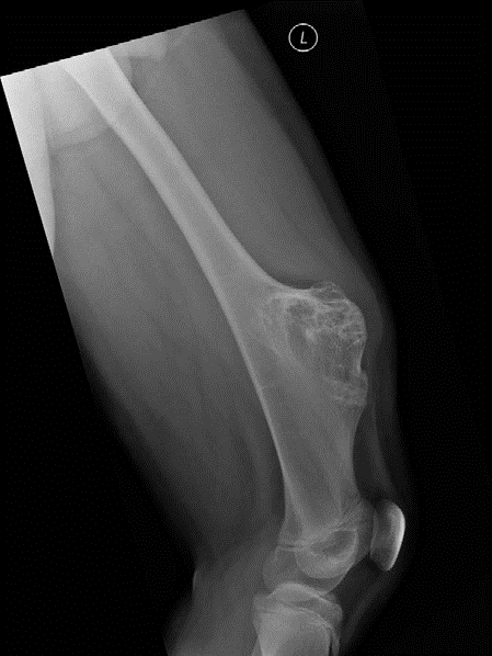 Illustration of examination question osteochondroma - Dr. Mohammed Hutaif