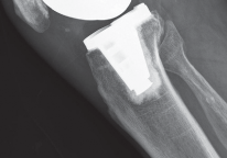 Illustration 39 for Minimize Pain, Maximize Recovery: TKA with Parapatellar
