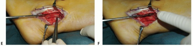 Illustration 22 for Beyond Primary Repair: Solutions for Peroneal Tendon Subluxation