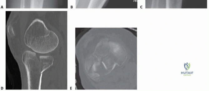 Operative Management of Pilon and Complex Ankle Fractures: A Masterclass in Distal Tibial Trauma