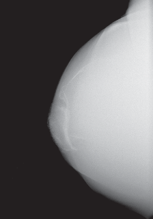Illustration of valgus total knee - Dr. Mohammed Hutaif