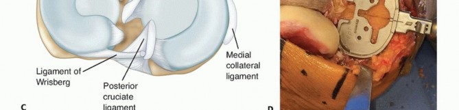 Illustration 18 for Achieve Lasting Pain Relief with Cemented Total Knee Arthroplasty