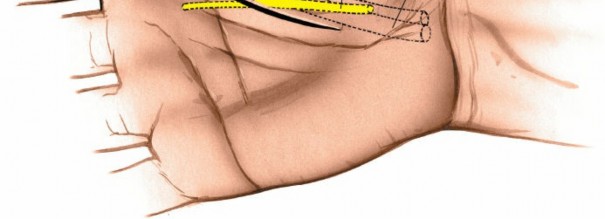 Illustration 231 for Essential Surgical Approaches: Uncover Every Aspect of the Wrist