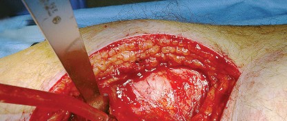 Illustration 22 for Unlock the Figure Posterior Approach to the Hip