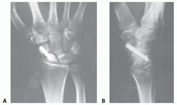 Partial Scaphoid Excision of Scaphoid Nonunions