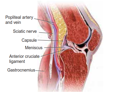 Illustration of knee arthrodesis knee - Dr. Mohammed Hutaif
