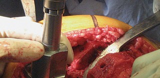 Illustration 49 for Posterior Stabilized Technique: Essential Insights for TKA Success