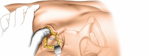 Illustration 14 for Expert Guide: Ulna and Wrist External Fixation Pin Placement