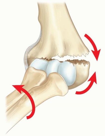 Mastering Pinning of Supracondylar Fractures: A Surgical Guide
