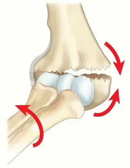 صورة توضيحية لـ كسور فوق اللقمة في عظم العضد لدى الأطفال: دليل شامل للوالدين مع الأستاذ الدكتور محمد هطيف