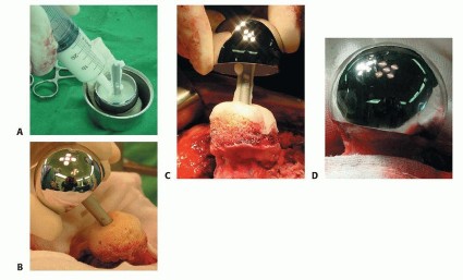 صورة طبية: ترميم مفصل الورك: الحل الأمثل للحفاظ على عظم رأس الفخذ في صنعاء مع الدكتور محمد هطيف
