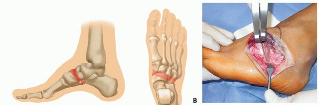 Illustration 33 for How Achilles Tendon Lengthening Fixes Equinocavovarus Foot