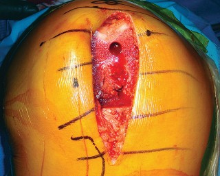 Illustration 25 for Mastering TKA: Essential Methods of Rotational Alignment