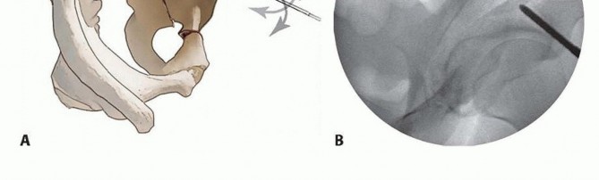 Illustration 24 for Restore Hip Health: Pelvic Osteotomy for Acetabular Dysplasia & CEA of Less