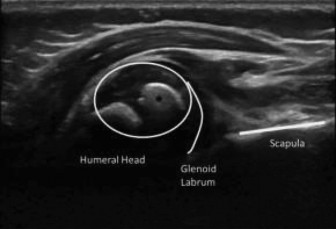 Illustration 3 for Diagnosing Brachial Plexus Birth: Newborn Arm Paralysis Case