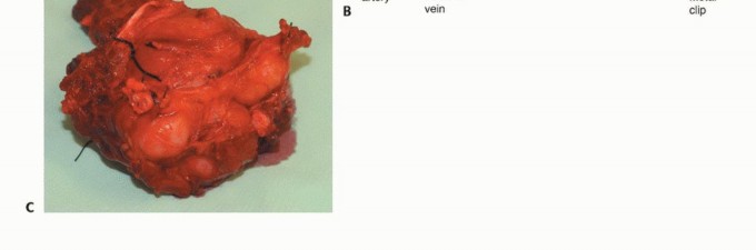 صورة طبية: استئصال أورام العضلات المقربة في الفخذ: الحفاظ على الطرف بتقنيات متقدمة مع الأستاذ الدكتور محمد هطيف في صنعاء