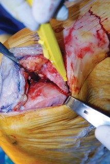 Illustration 26 for Knee Arthroplasty: Avoiding Pitfalls & Benefiting from UKA