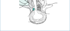 Illustration 71 for Mastering Thoracolumbar Surgery: Full Operative Planning