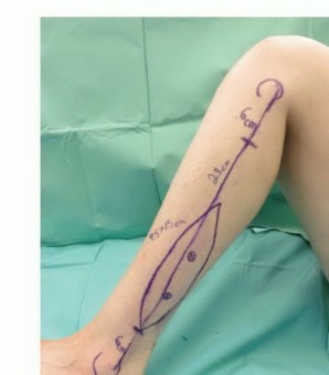 صورة طبية: ترقيع الشظية الوعائي الحر: حلول متقدمة لعيوب العظام المعقدة