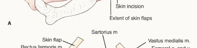 صورة طبية: استئصال ساركوما العضلة الرباعية مع الحفاظ على الطرف: دليل شامل للمرضى مع الأستاذ الدكتور محمد هطيف في صنعاء