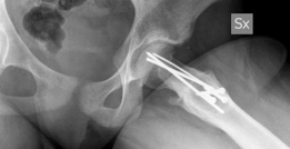 Illustration 6 for Solving Unstable SCFE: Subcapital Realignment with Extended Retinacular Flap