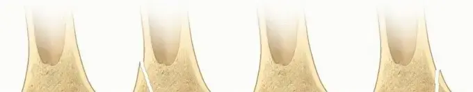 صورة توضيحية لـ كسور صفيحة النمو في عظم الفخذ البعيد لدى الأطفال: دليل شامل للمرضى وأولياء الأمور