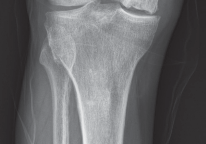 Illustration 2 for Minimize Pain, Maximize Recovery: TKA with Parapatellar