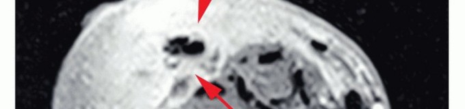 صورة توضيحية للتشريح العظمي للذراع ومستويات البتر المحتملة