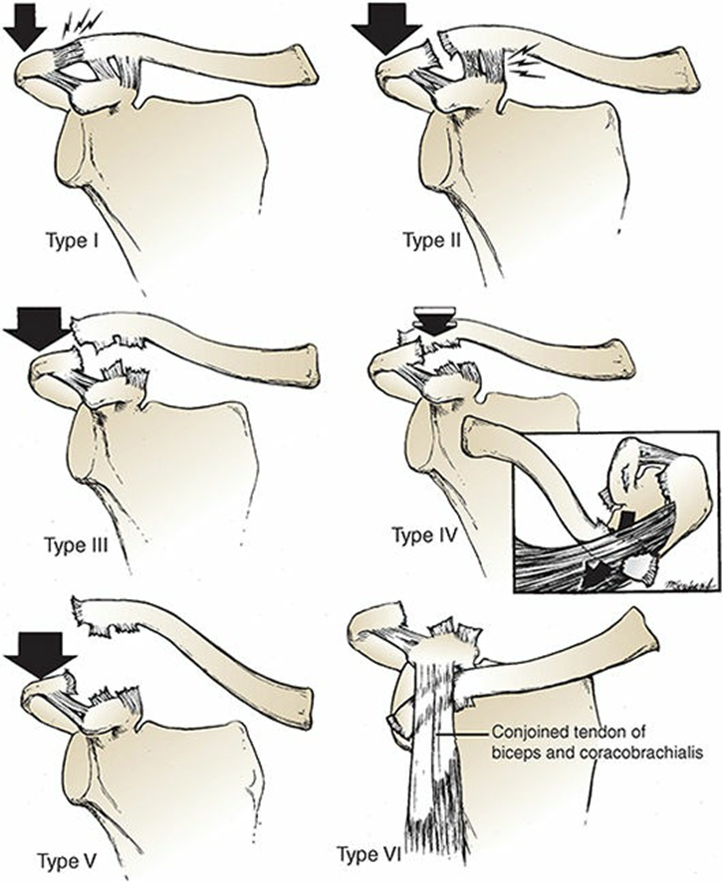 Heal Your AC Joint Injury: Causes, Symptoms & Treatment Guide