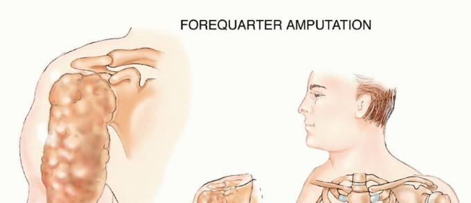 Forequarter Amputation: Essential Guide to This Complex Forequarter Procedure