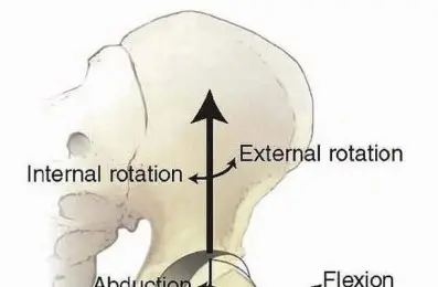 صورة توضيحية لـ استعادة صحة مفصل الفخذ جراحة قطع العظم الحوضي لعلاج خلل التنسج الحُقّي في صنعاء