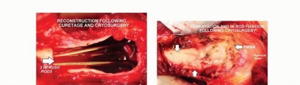 صورة طبية: تجنب الجراحة الكبرى: علاج أورام العظام بالنيتروجين السائل بتقنية الصب المباشر