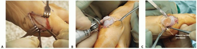 Distal Chevron Osteotomy: Essential Techniques for Success