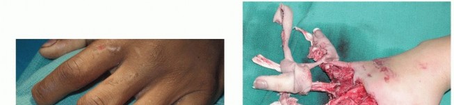  Revascularization and Replantation of the Digits  L. Scott Levin