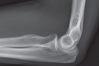 Missed Coronoid Fractures? Identify Complex Coronoid Injuries