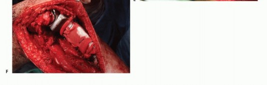 صورة طبية: معالجة الأورام المعقدة في قصبة الساق القريبة حلول الحفاظ على الأطراف