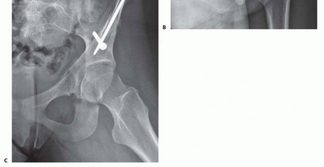 Illustration 27 for Restore Hip Health: Pelvic Osteotomy for Acetabular Dysplasia & CEA of Less