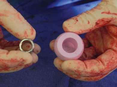 صورة طبية: تقنية الجذع القصير لاستبدال مفصل الورك الكلي: نهج الأستاذ الدكتور محمد هطيف لتدخل جراحي أقل ونتائج أفضل