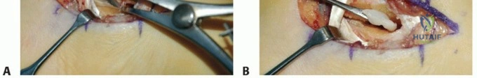 Extensor Hallucis Brevis Tenodesis: Comprehensive Surgical Guide