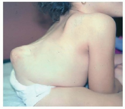 Illustration of kyphectomy in spina - Dr. Mohammed Hutaif