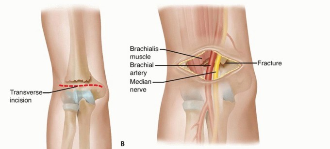 Open Reduction of Supracondylar Fractures of the Humerus