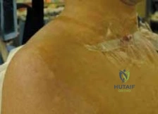 Illustration of capsular releases for loss - Dr. Mohammed Hutaif